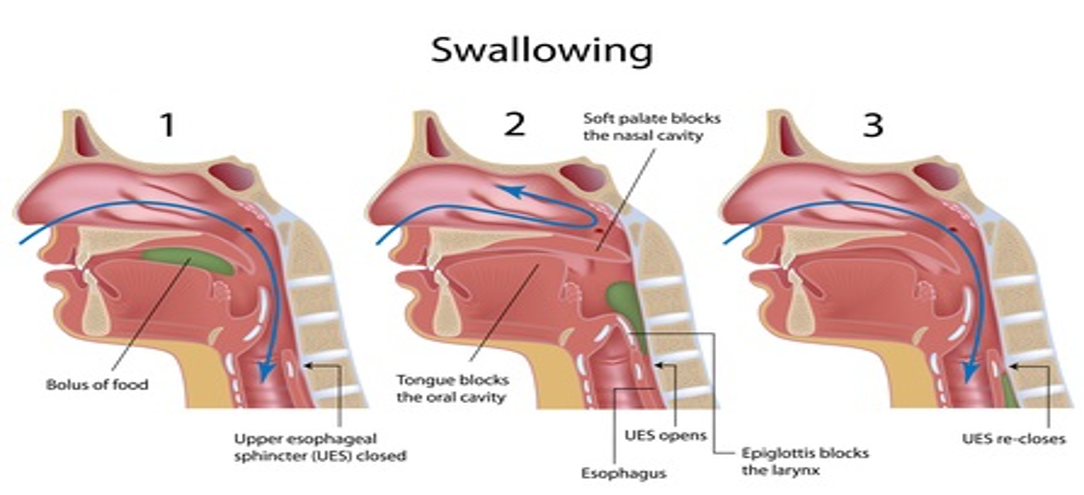 Dysphagia